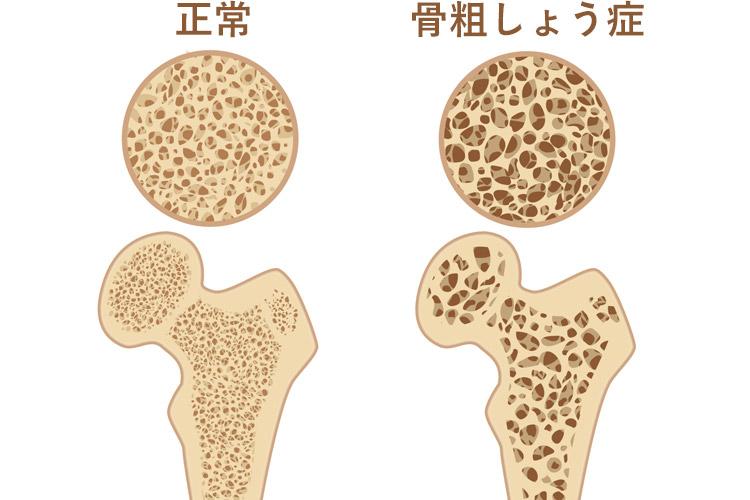 骨粗鬆症イメージ